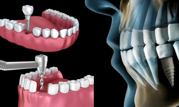 3d surgical dental medical animation anatomy animation 3d teeth surgery video
