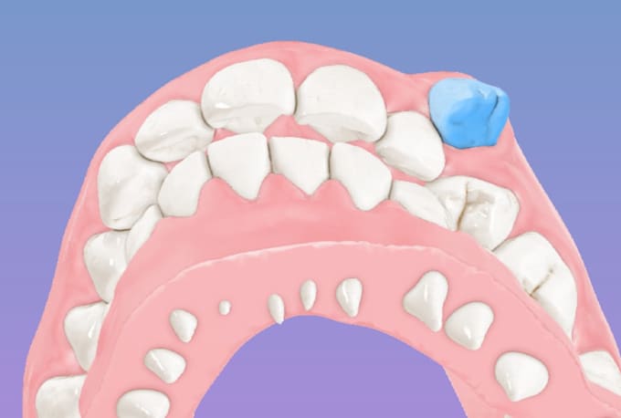design custom clear aligner treatment plan