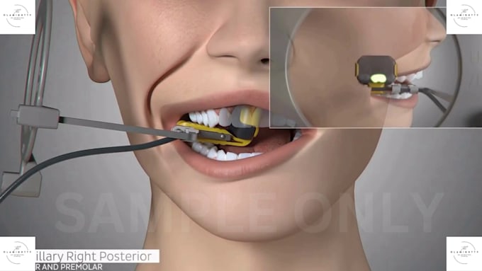 create stunning 3d dental video 3d medical animation for devices and  procedures