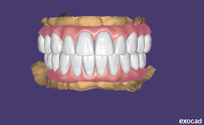 design smile, veneers, crown, bridge, implants using exocad