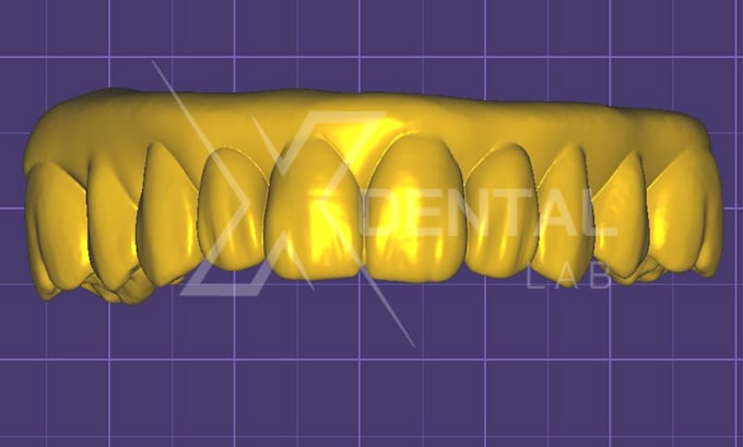 design crowns and bridges in exocad