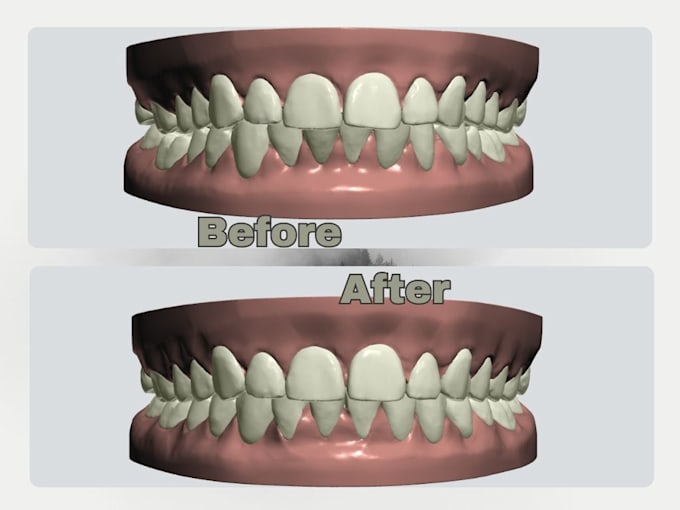 design best clear aligners treatment planning