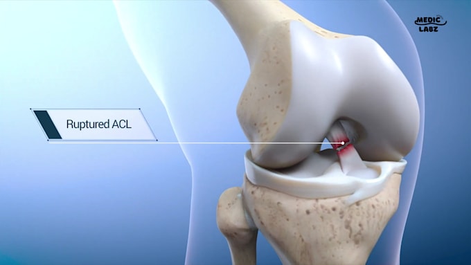 3d medical animation anatomy surgical illustration video medical device ...