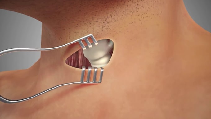 Create 3d medical surgery animation 3d medical explainer 3d medical ...