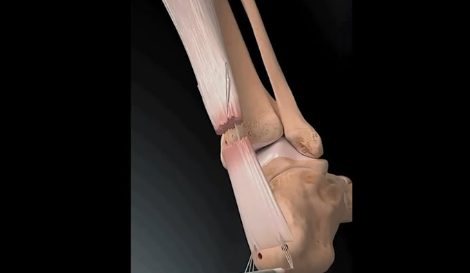 create 3d medical animation, anatomy, surgery animation, 3d explainer video