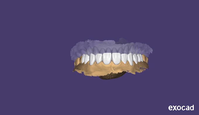 create dental restorations using exocad