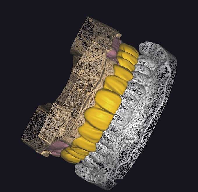 create accurate dental prosthesis designs using exocad