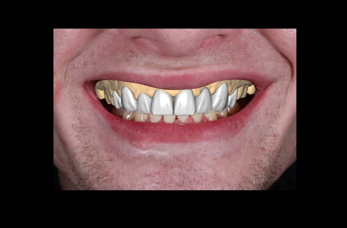 design dental waxup dsd using exocad