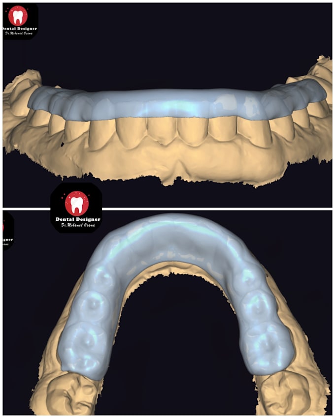 design a precise bite splint , night guard in exocad  stl ready