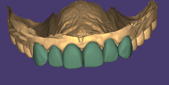 design crowns, bridges, veneers and implants using exocad