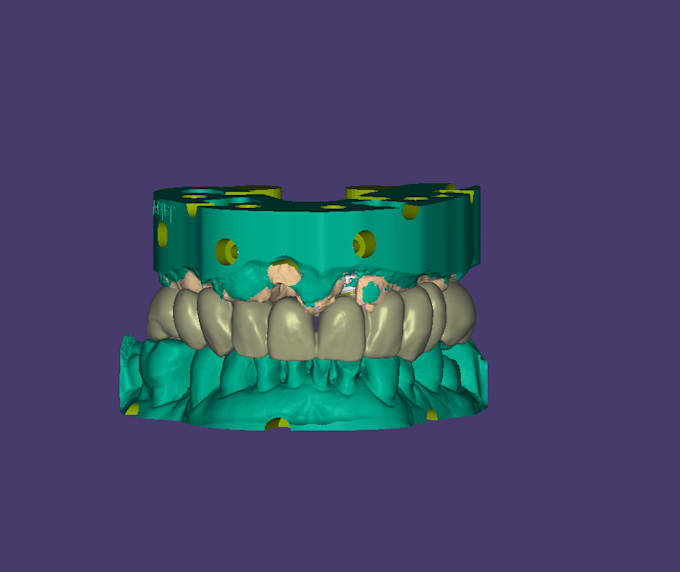 exocad implant dental design