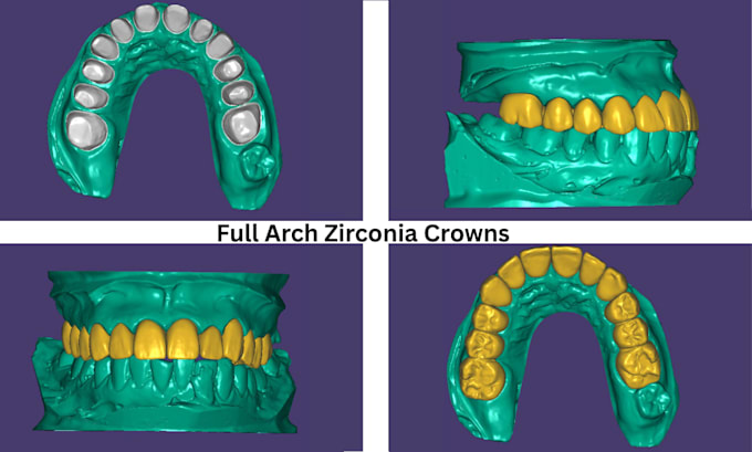 create high quality dental restorations using exocad