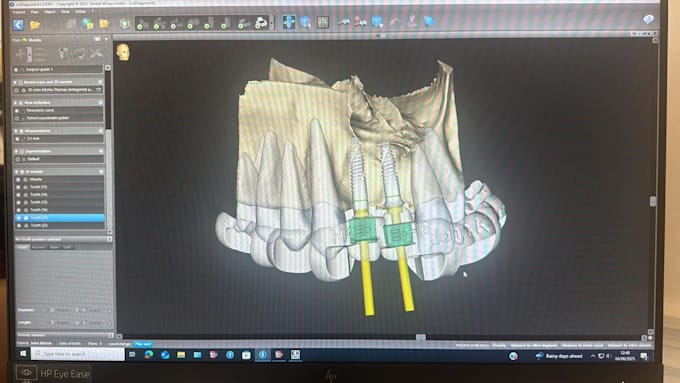 create dental implant planning and digital surgical guides using codiagnostix