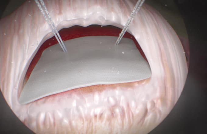 create a 3d medical animation, 2d medical explainer video, healthcare explainer