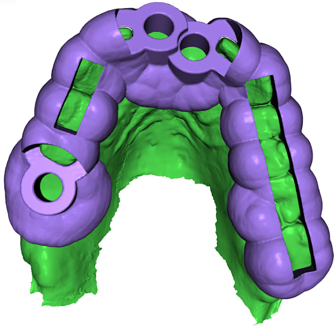 design a surgical guide for implant surgery