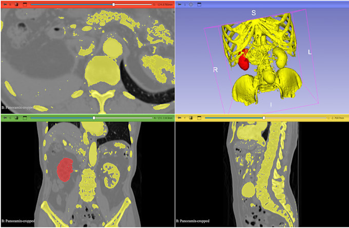 do ct and mri scans segmentation using 3d slicer