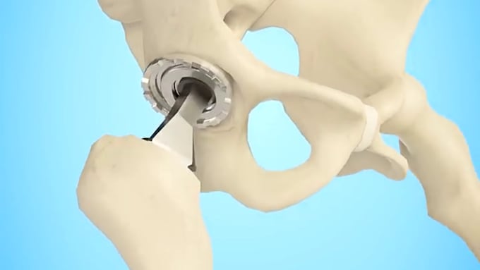 create 3d medical animation and surgical procedure animation for explainer video