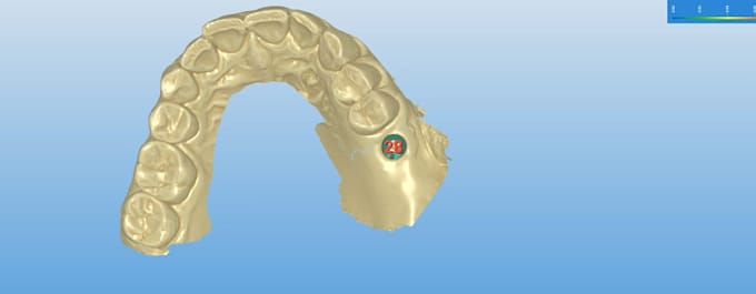 do exocad dental implant design fast and accurately
