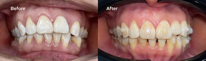 make accurate clear aligner setups with 3shape