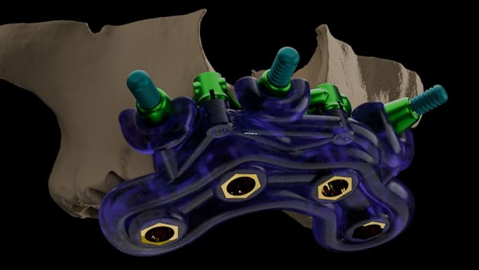 do surgical stackable guide