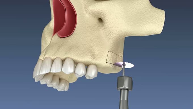 create realistic 3d dental implant animation and dental surgery animation