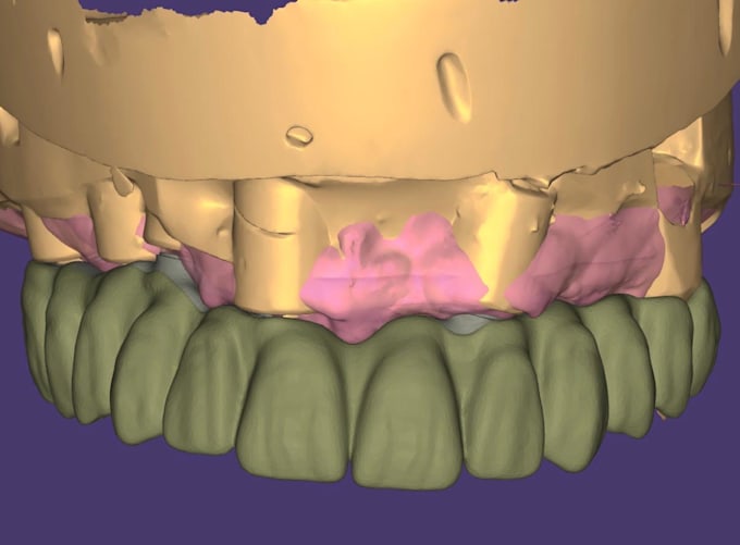 design crowns, bridges, implants, full arch cases using exocad