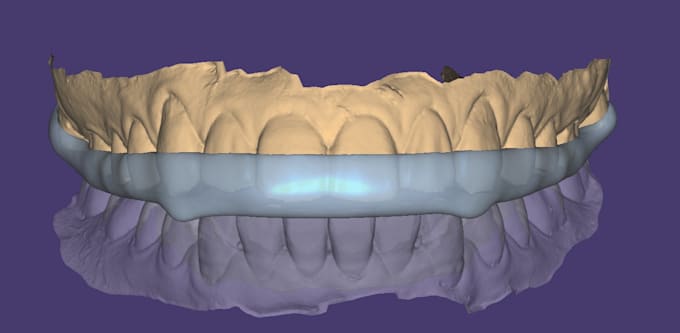 do dental cad design for splints in exocad