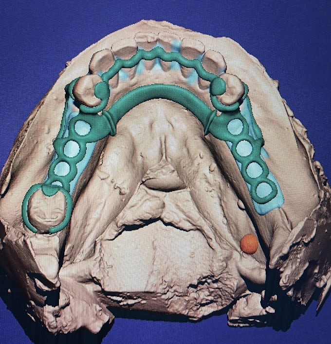 create high quality dental cad desings using exocad