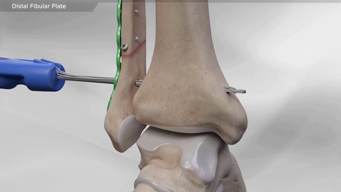 create professional 3d surgical and orthopedic medical animations