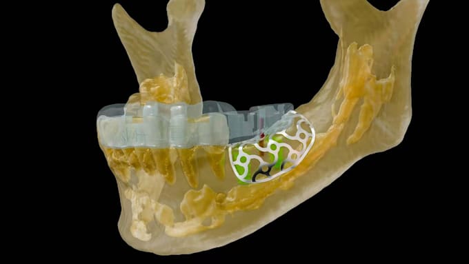 digital implant planning surgical guide design  digital denture cad