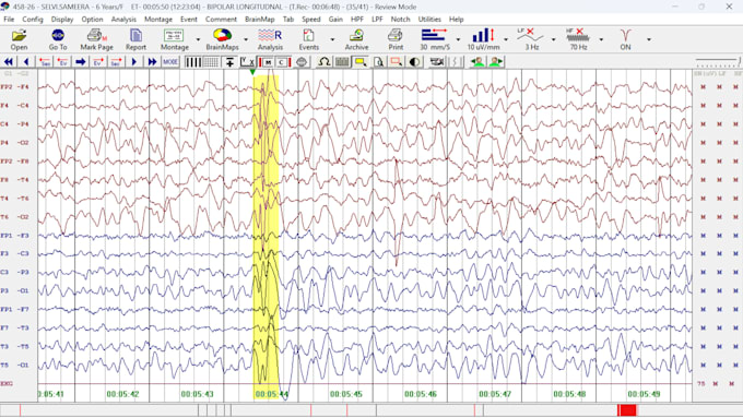 doeeg,ncv accurate report interpretation analysis and format