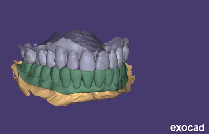 design professional exocad dental cad restorations