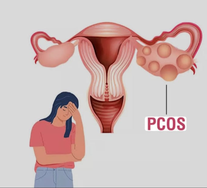write SEO pcos articles, diet plans and lifestyle tips