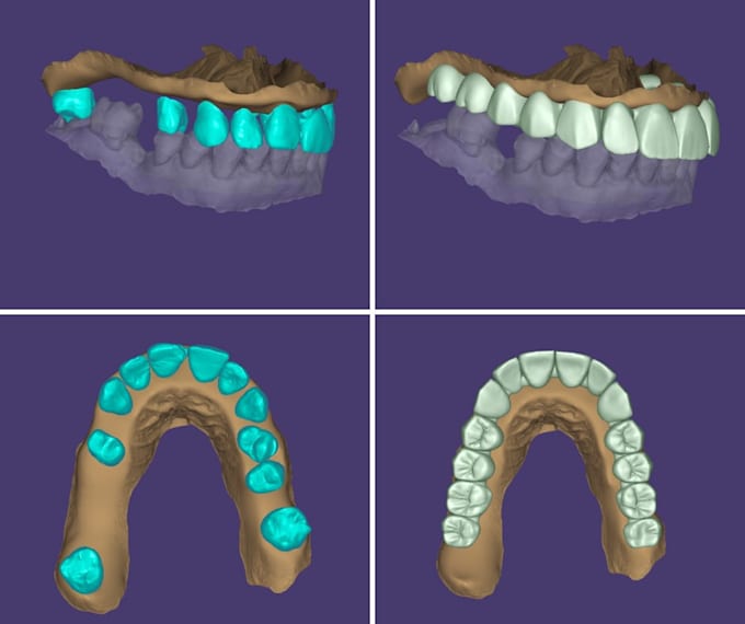 design precise exocad dental crowns, bridges and veneers