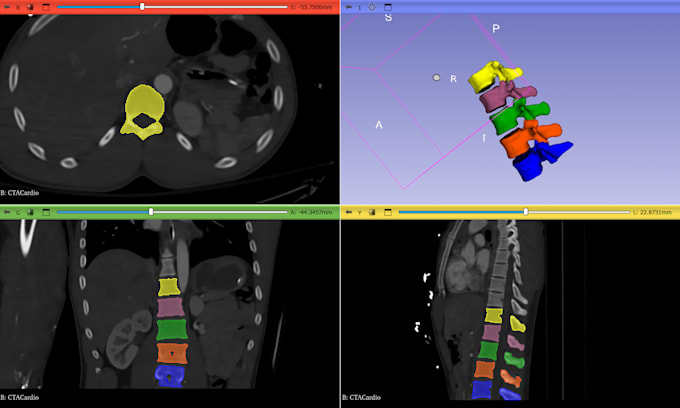 do 3d medical image segmentation and dicom conversion to stl