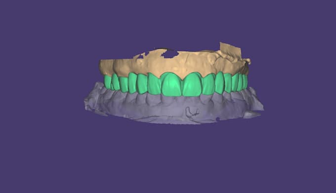 design custom crowns, bridges using exocad