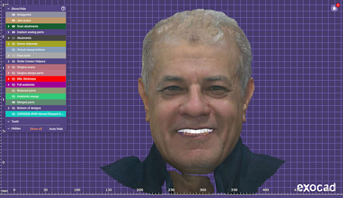 design professional dental restorations using exocad