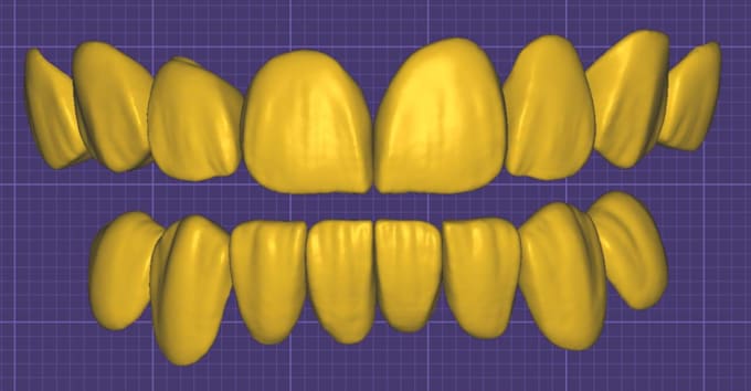 create professional 3d dental cad designs using exocad