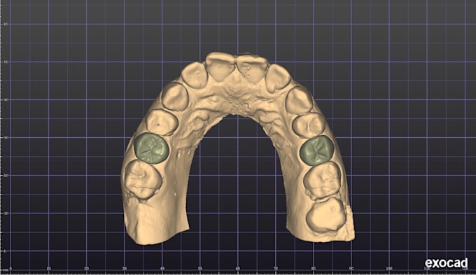 create professional dental cad designs in exocad