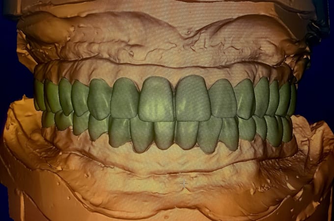 expert dental design on exocad crowns, bridge and more