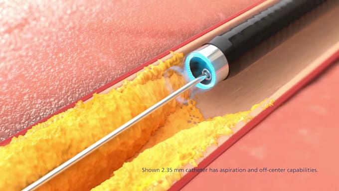 do 3d medical device, catheter, vascular explainer and surgical device animation