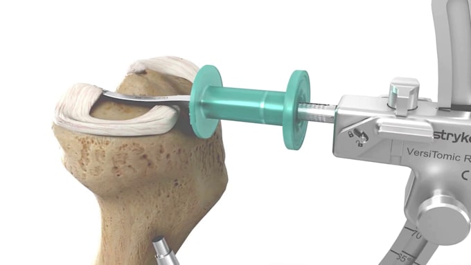 create 3d surgical procedure, medical device and anatomy visualization video