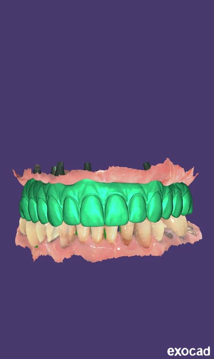 design all on x dental prosthesis using exocad
