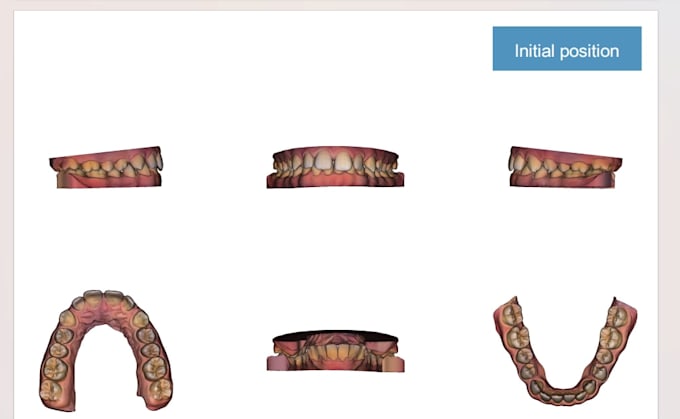 design 3d clear aligner setup and staging with maestro 3d