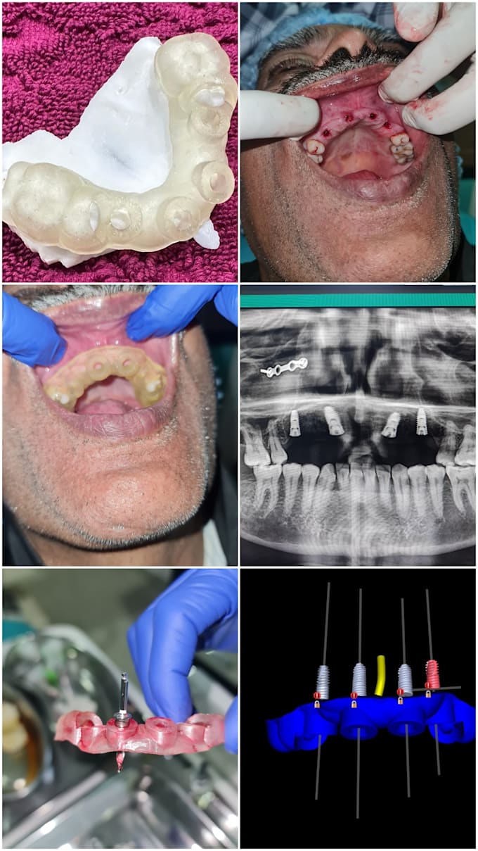 plan and design surgical guide