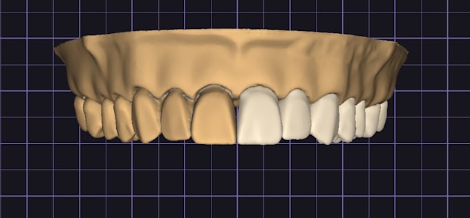 make dental crown design on prepared tooth for you