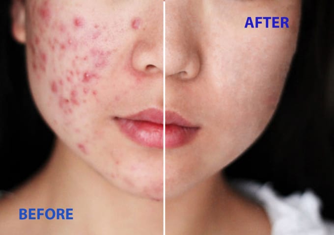 Remove Acne Blemishes Or Scars On Your Photos In 24 Hours By St Roman