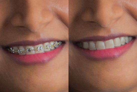 remove braces or whiten teeth