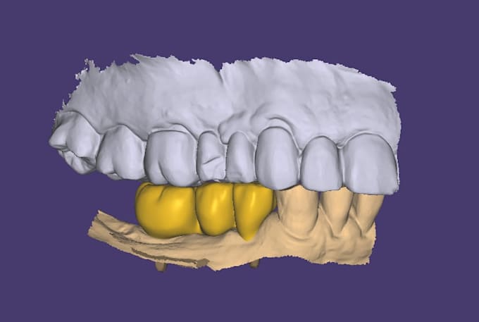 design dental crowns and bridges using exocad