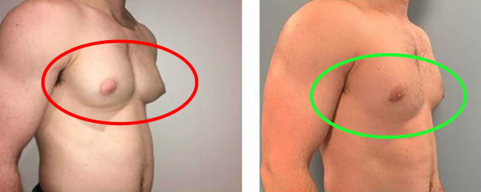 provide the guide to remove lower chest gyno problems